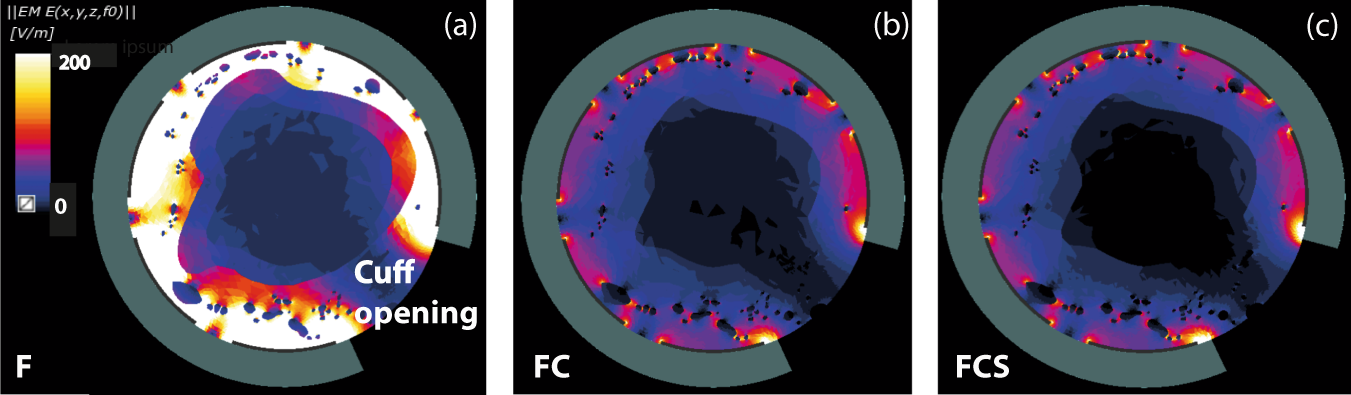 Fig. 3: Electric field distribution in axial cross section centred on one electrode in the human model.