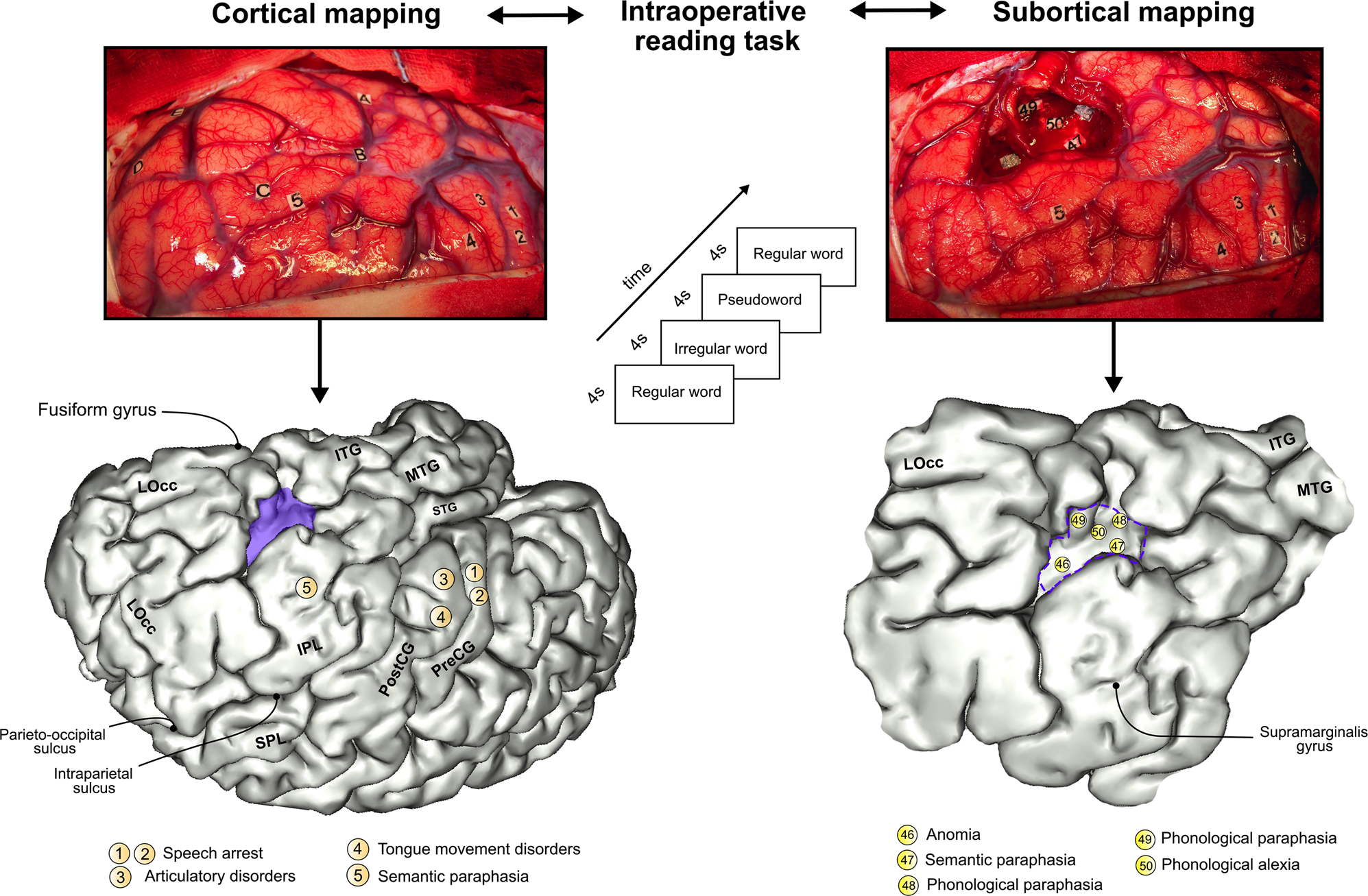 White matter disconnectivity fingerprints causally linked to dissociated  forms of alexia | Communications Biology