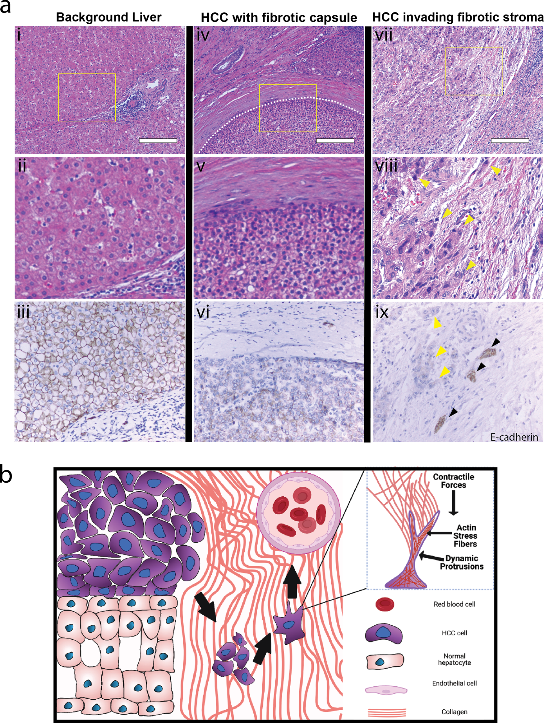 Cytoskeletal dynamics regulates stromal invasion behavior of distinct liver  cancer subtypes | Communications Biology