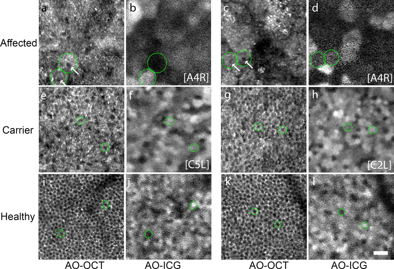 Fig. 2: Multimodal imaging corroborates the finding that the RPE cells are enlarged in choroideremia.