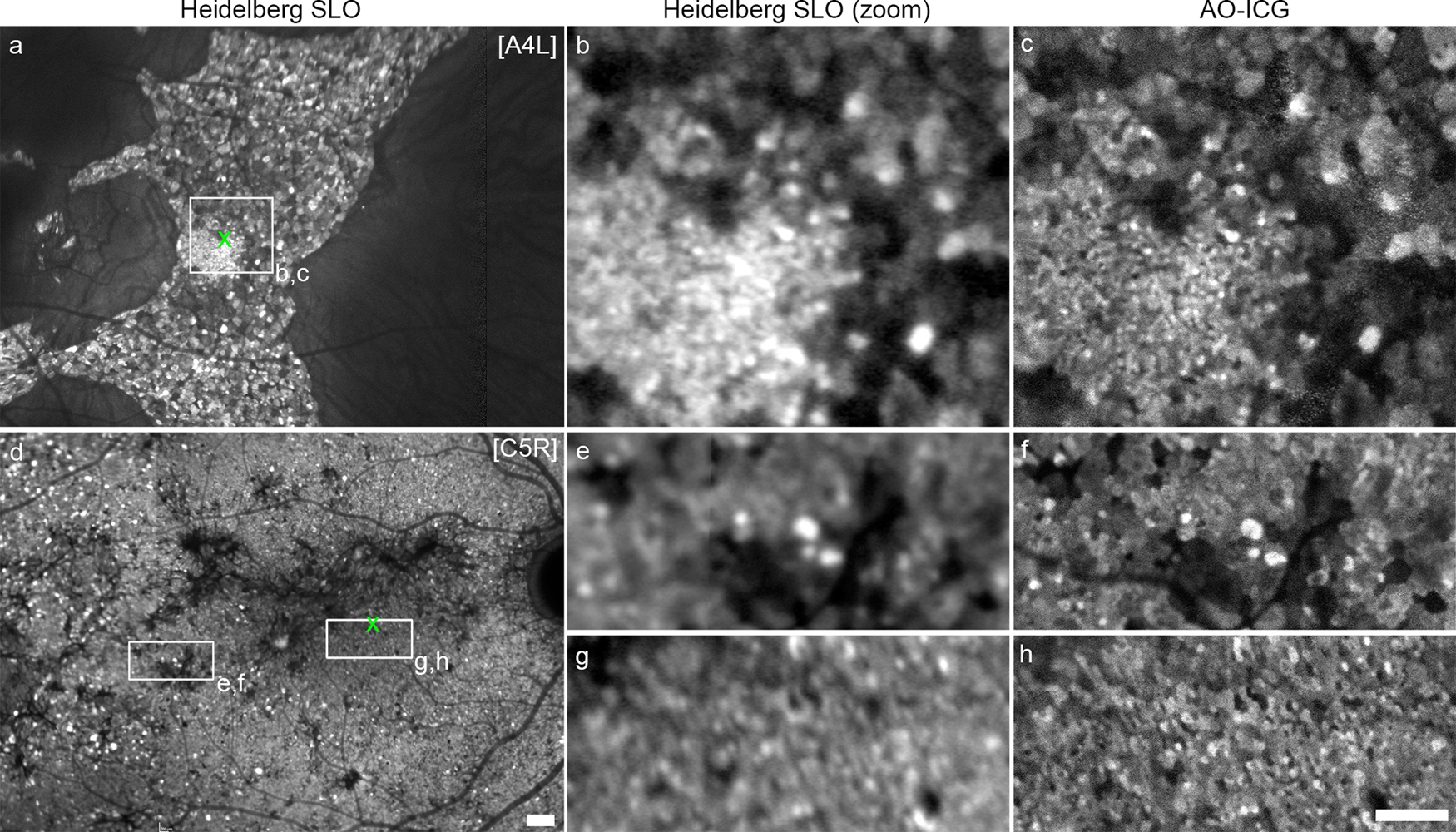 Fig. 5: Detection of RPE cell polymegathism using late phase ICG imaging.