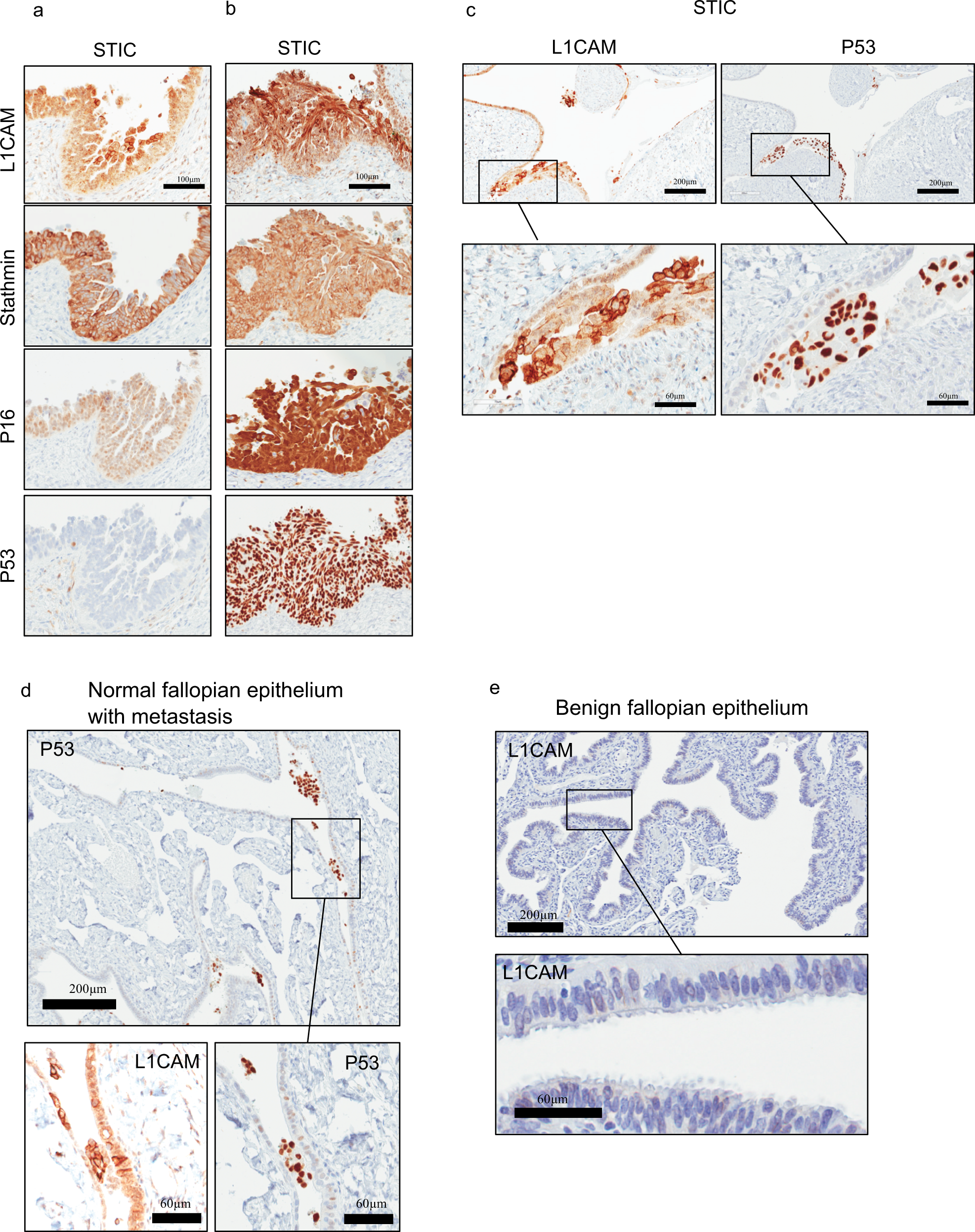Fig. 3: L1CAM expression in STIC lesions.