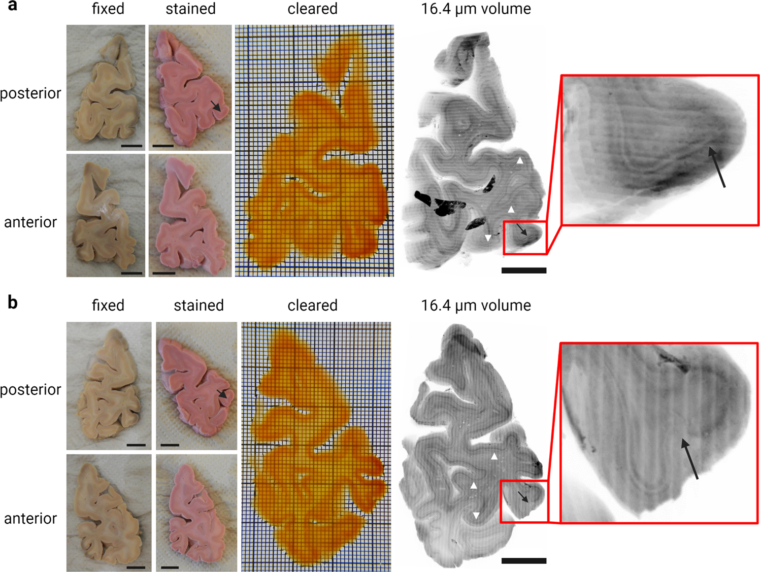 Representative images of a (A) 3-mm and (B) 6-mm apical plug and