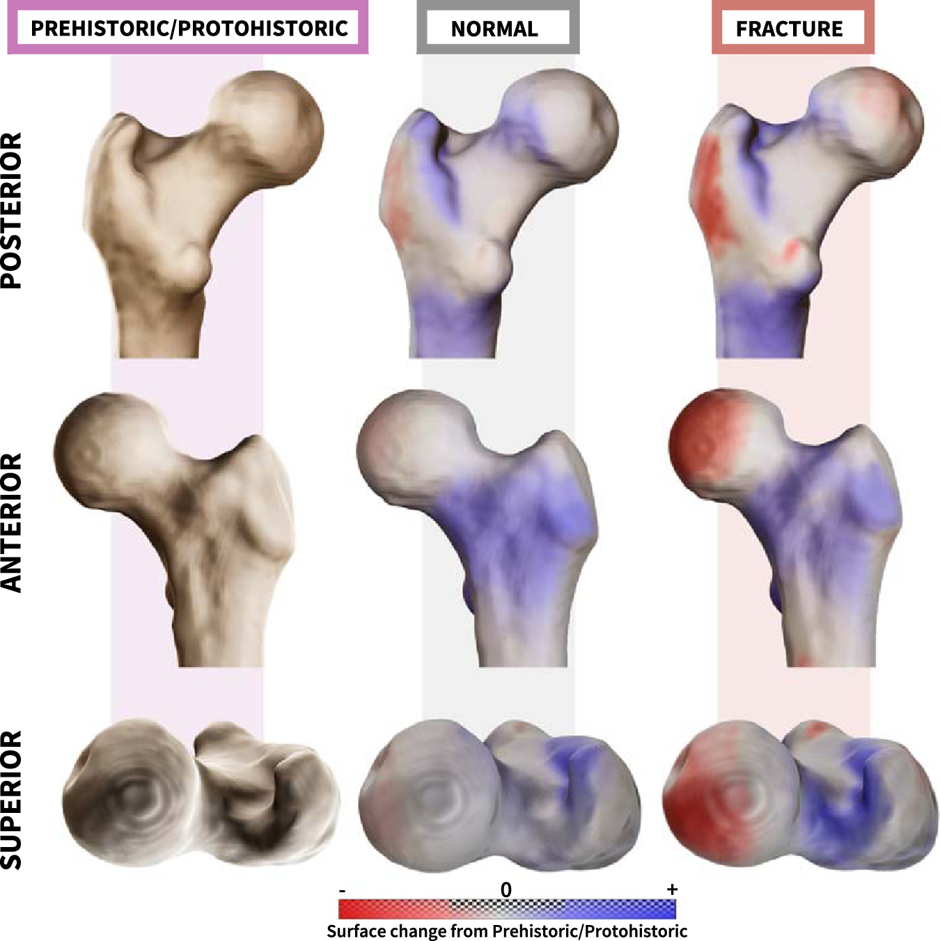 Fig. 4: Superimposition of the proximal femoral mean shape of recent humans (with or without a non-osteoporotic fracture) on the proximal femoral mean shape of the Prehistoric/Protohistoric group.