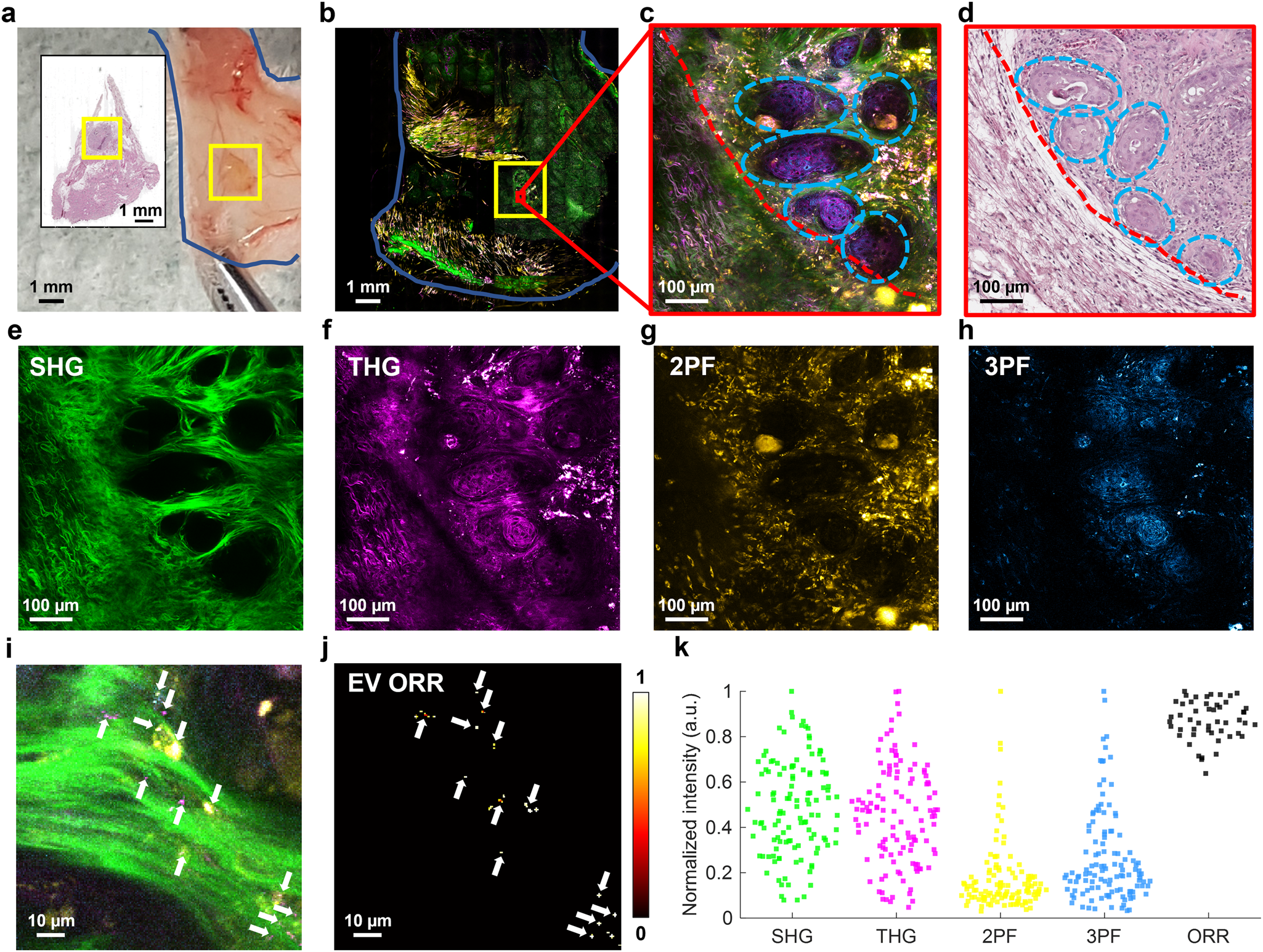 Fig. 2: Qualitative and quantitative in vivo imaging of PDAC tumor in PDX mouse using SLAM microscopy.