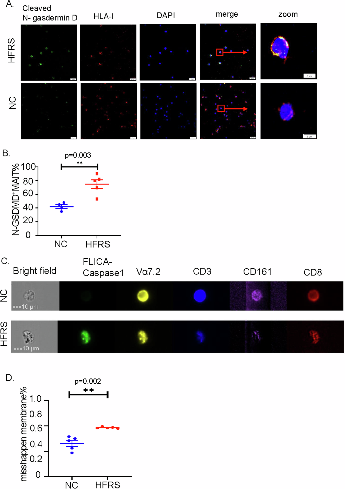 Fig. 4: Increased pyroptosis in MAIT cells was shown in HFRS patients.