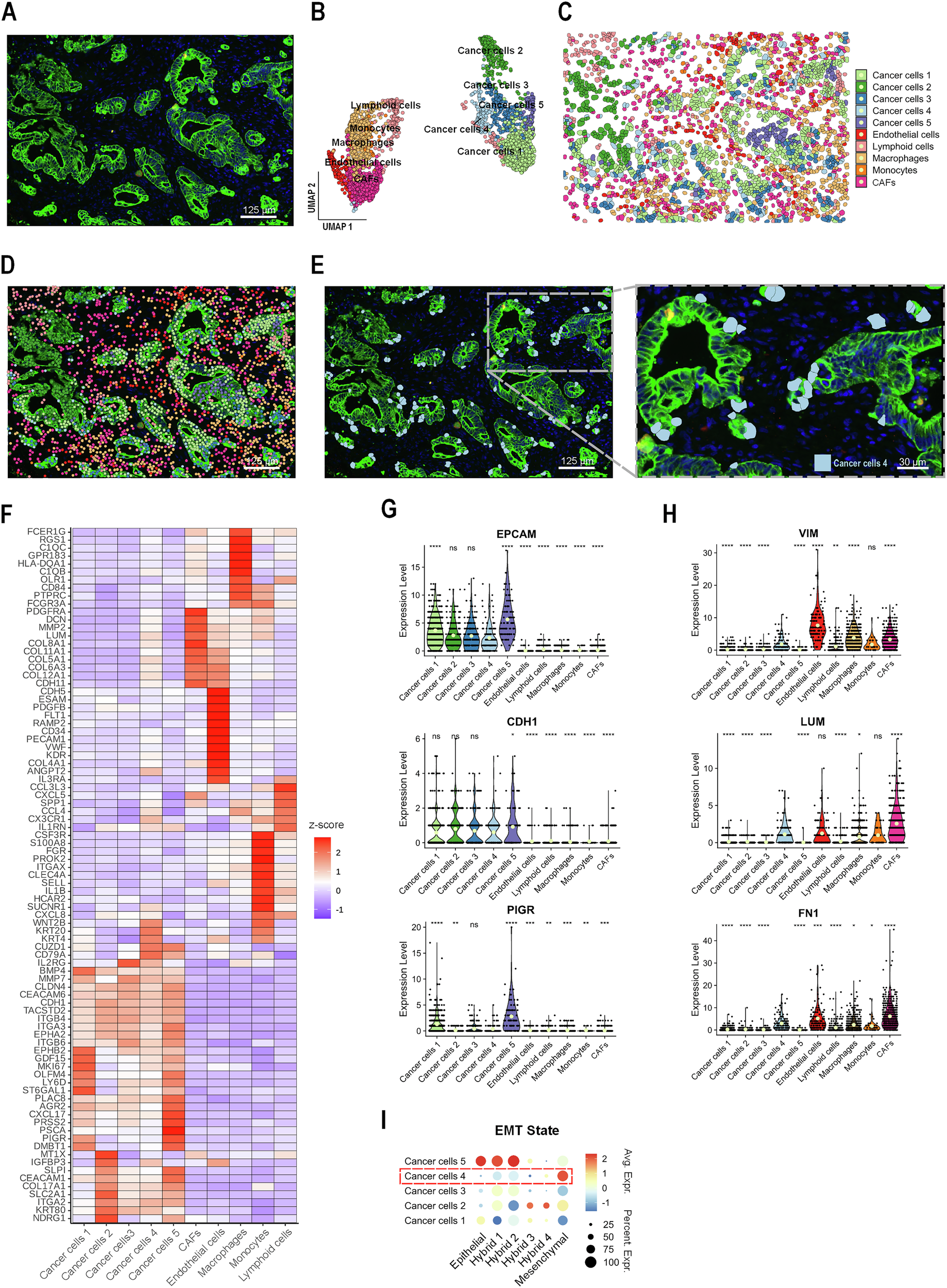 Cancer-associated fibroblasts shape the formation of budding cancer cells  at the invasive front of human colorectal cancer | Communications Biology