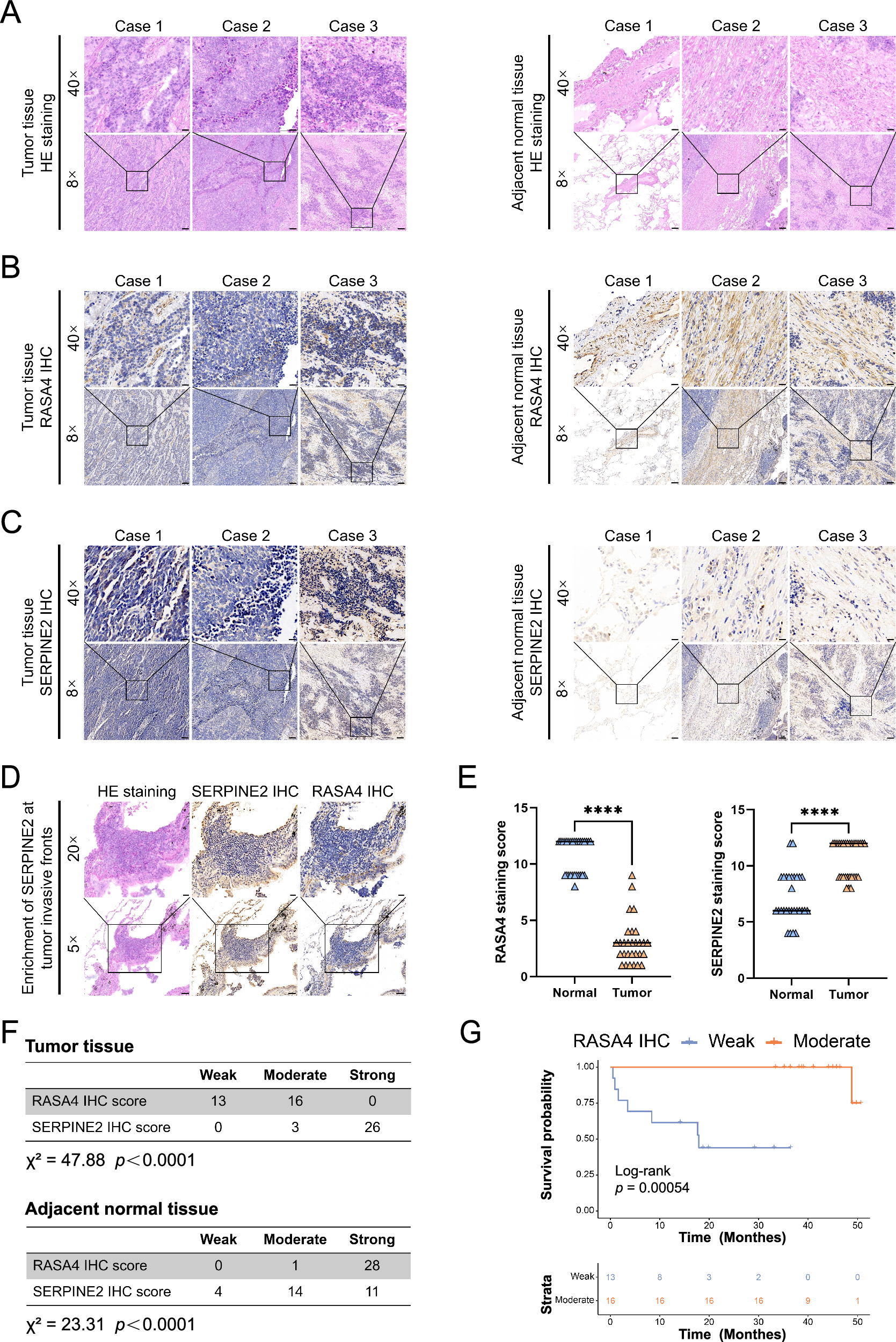 Fig. 6: RASA4 is down-regulated in SCLC tumor tissues and correlates with poor clinical prognosis.