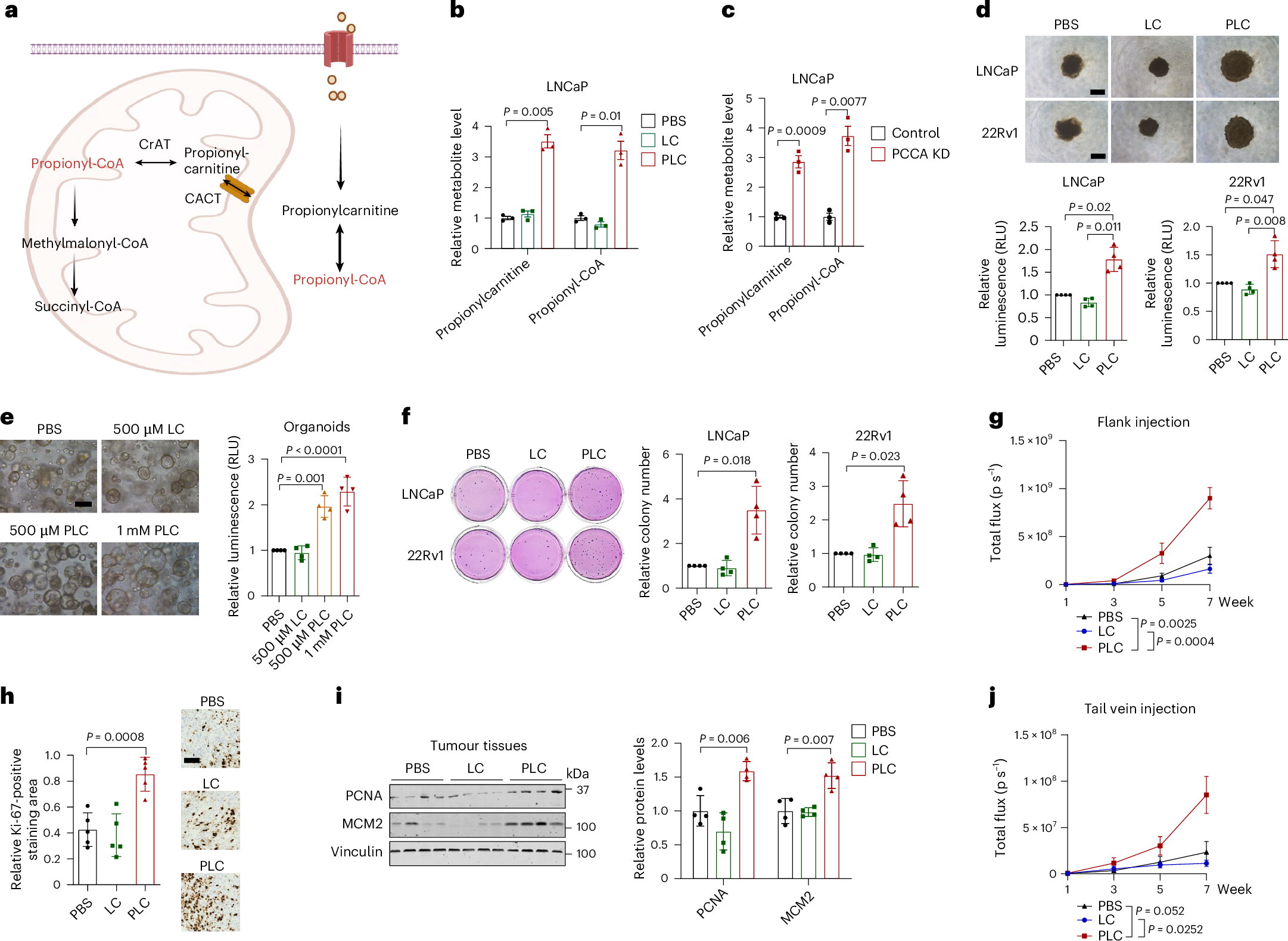 Isoleucine and valine promote prostate cancer progression via propionyl-CoA-mediated cholesterol metabolism