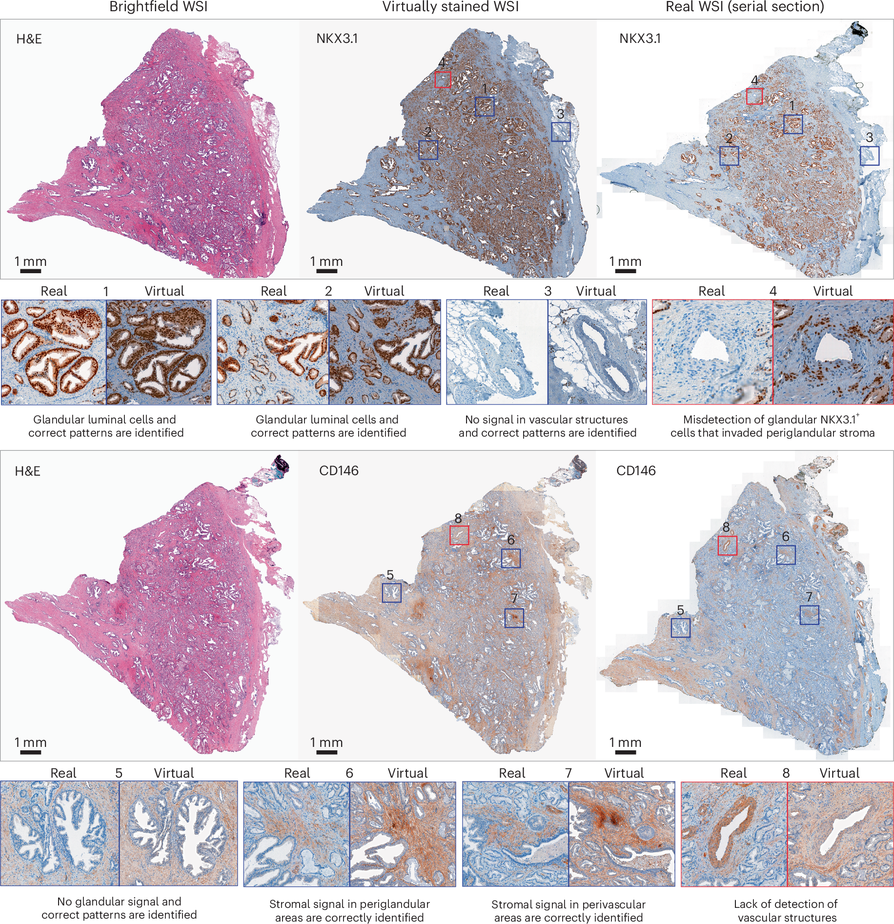 Fig. 4: Transfer learning from TMA to WSIs of prostate cancer tissue.