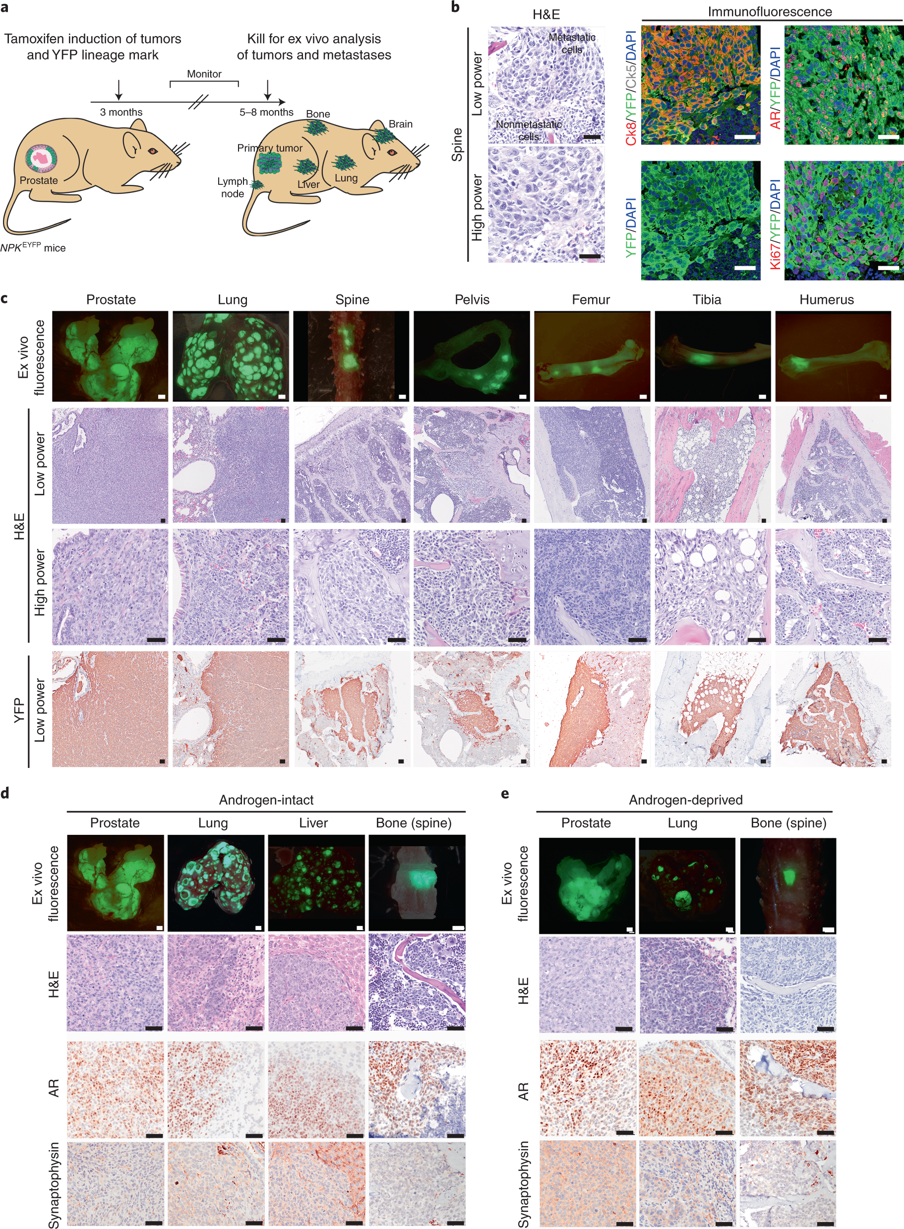 A Myc And Ras Co Activation Signature In Localized Prostate Cancer Drives Bone Metastasis And Castration Resistance Nature Cancer