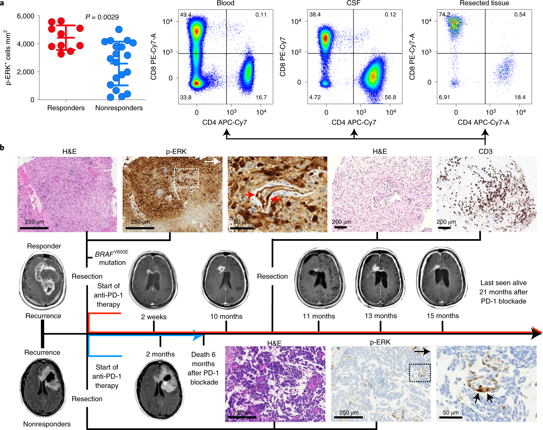 ERK1/2 phosphorylation predicts survival following anti-PD-1 immunotherapy  in recurrent glioblastoma | Nature Cancer