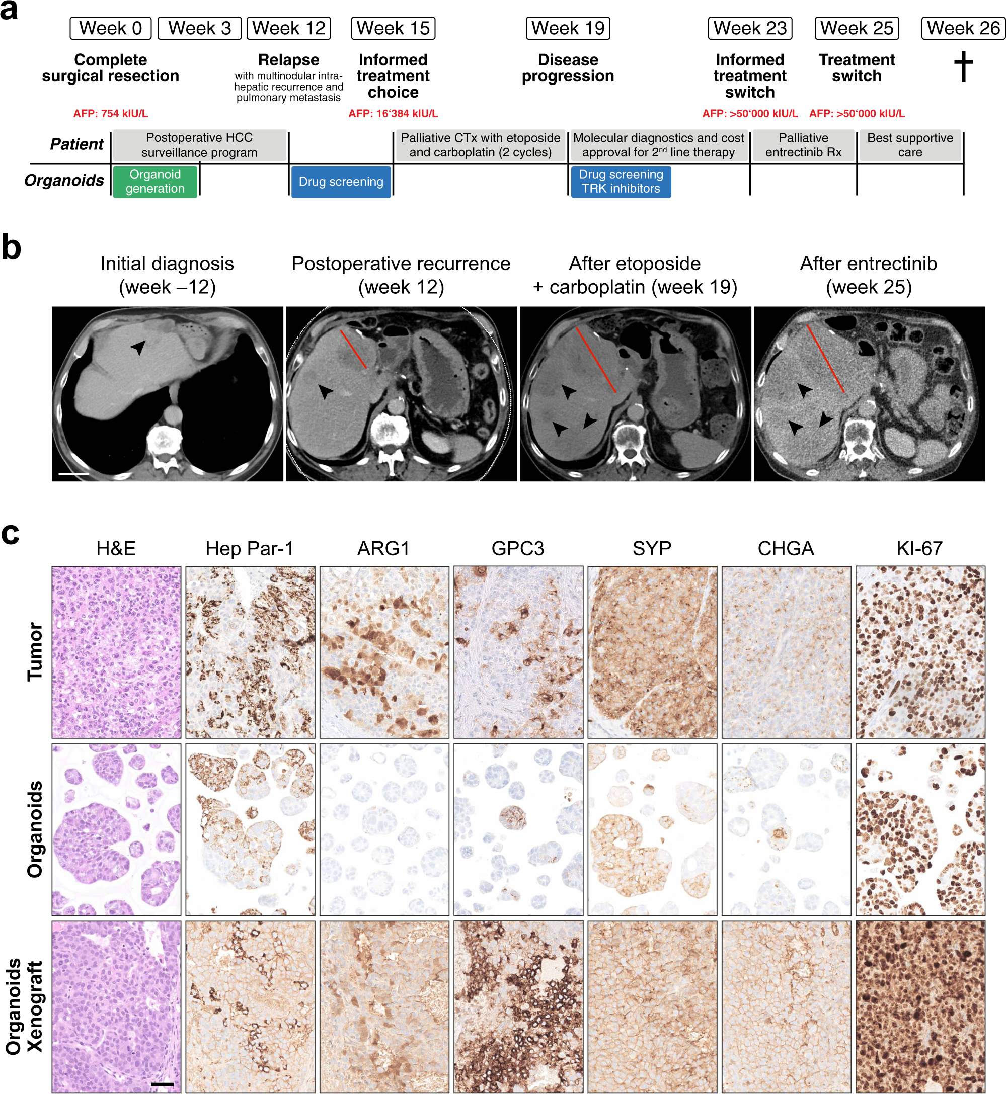 Patient-derived tumor organoids for personalized medicine in a patient with  rare hepatocellular carcinoma with neuroendocrine differentiation: a case  report | Communications Medicine, image size:1999x2175