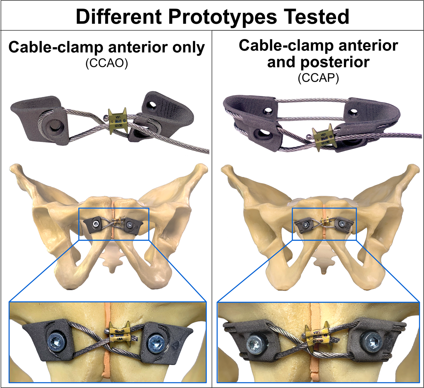 Development and preclinical evaluation of a cable-clamp fixation device for a disrupted pubic symphysis Communications Medicine