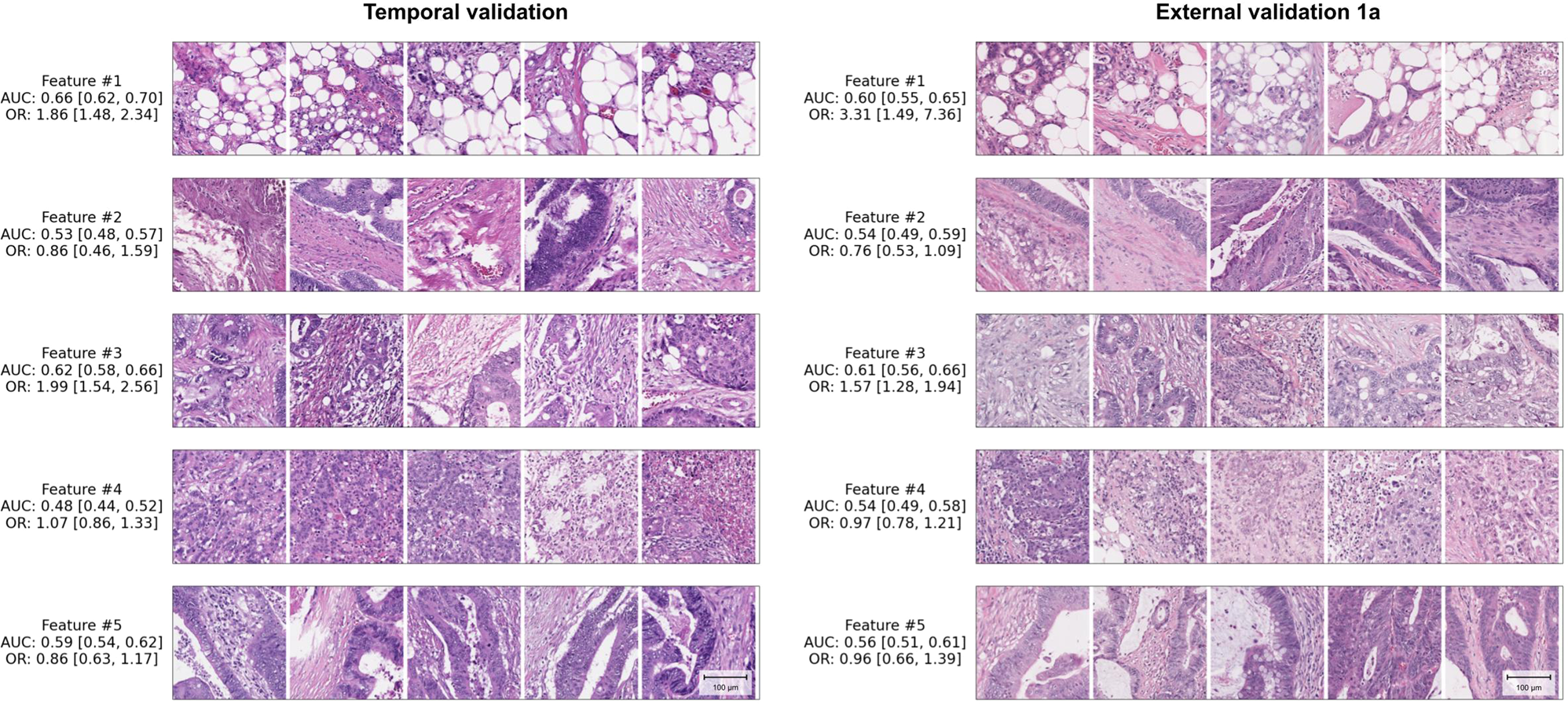 Fig. 2: Representative patches of machine-learned features associated with lymph node metastasis.