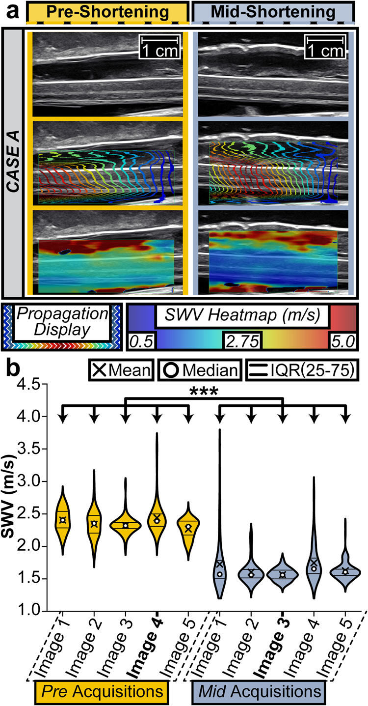 Fig. 4: Intraoperative use of TAUT for spinal cord stretch differentiation.