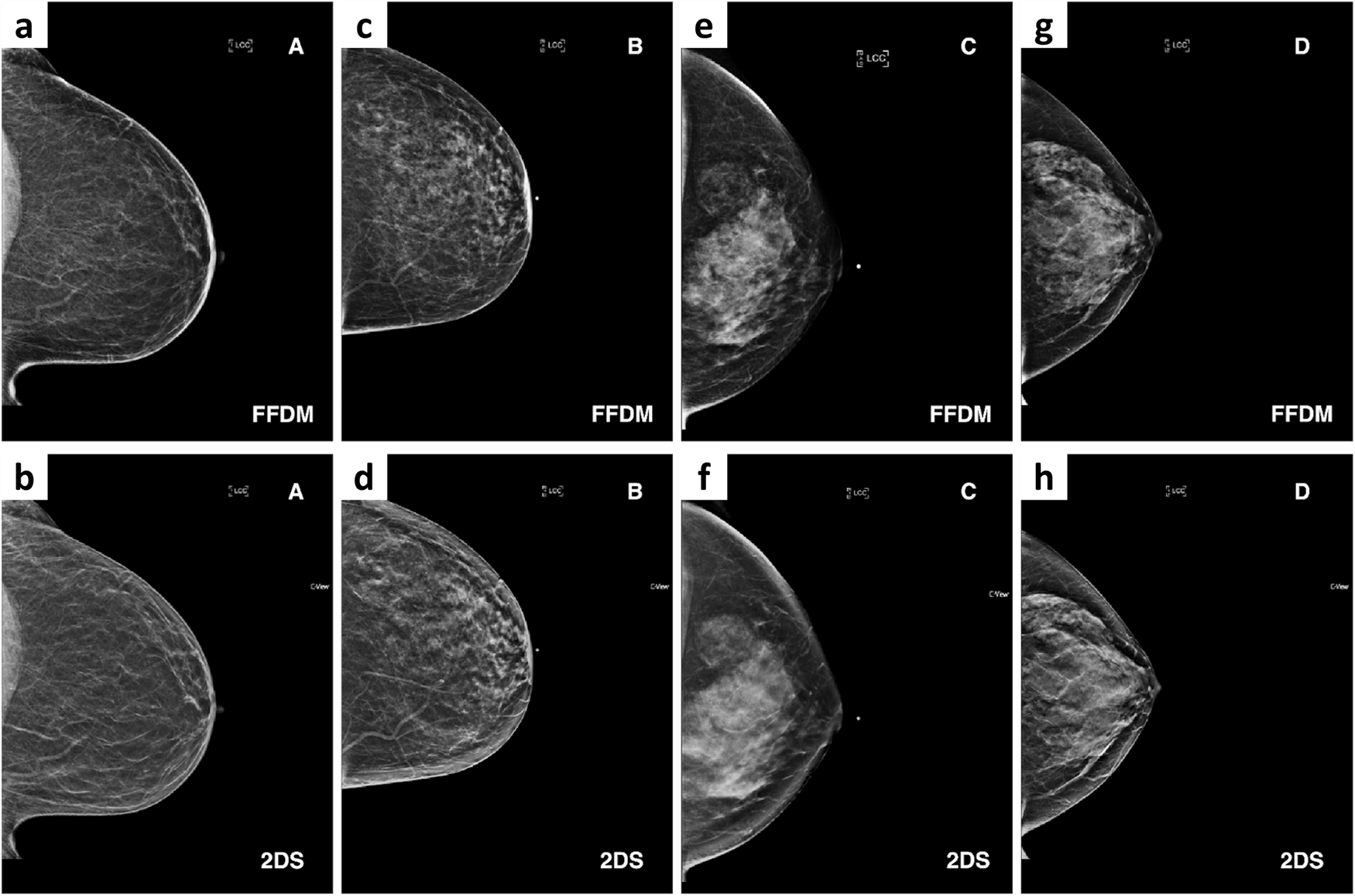 A-D Four representative cases of different breast size and parenchymal