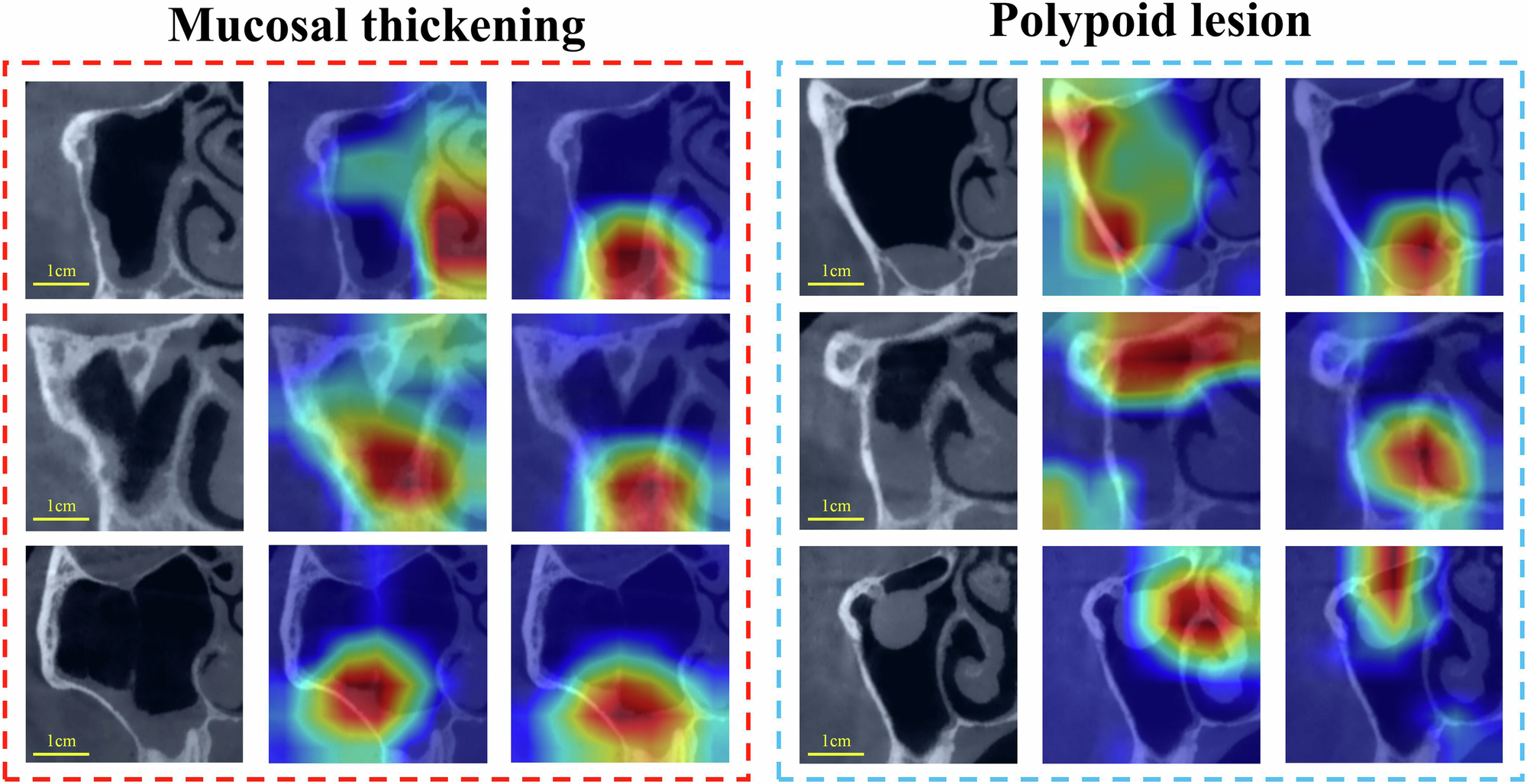 Fig. 4: Grad-CAM visualizations of ResNet50 before and after StyleGAN2-based dataset optimization.
