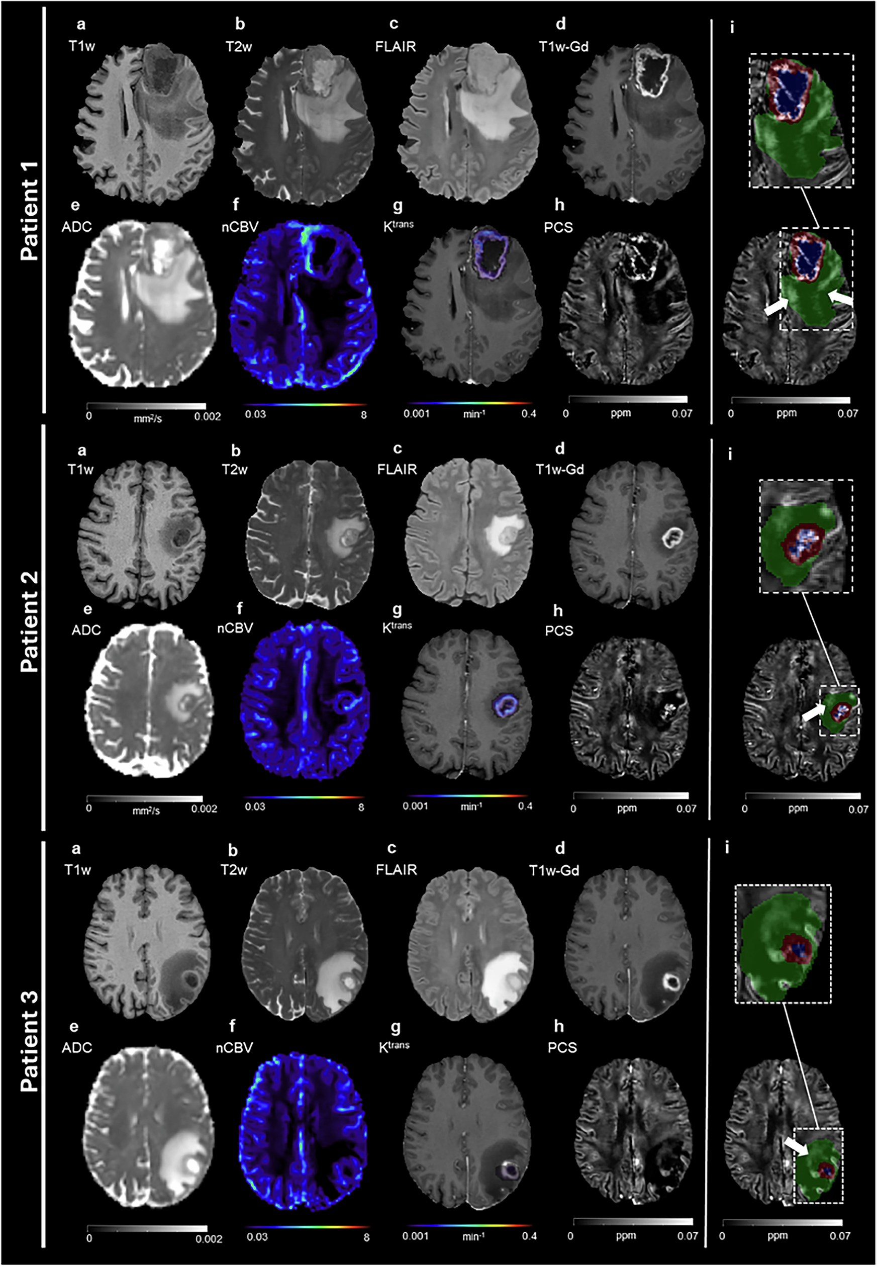 Fig. 1: PCS hyperintensity not visible on conventional MRI.