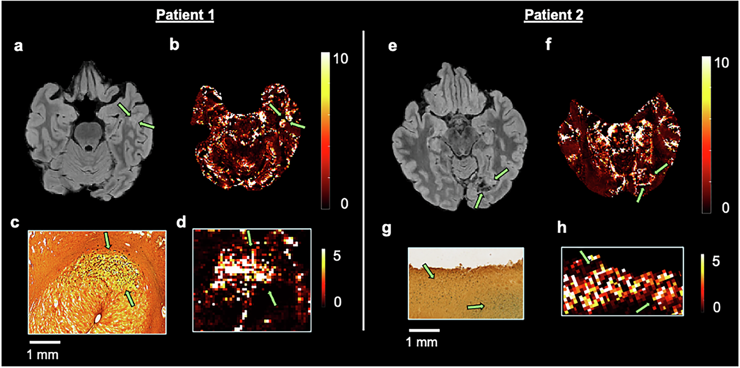 Fig. 5: Iron staining of tumor specimens confirms the biological origin of PDR.