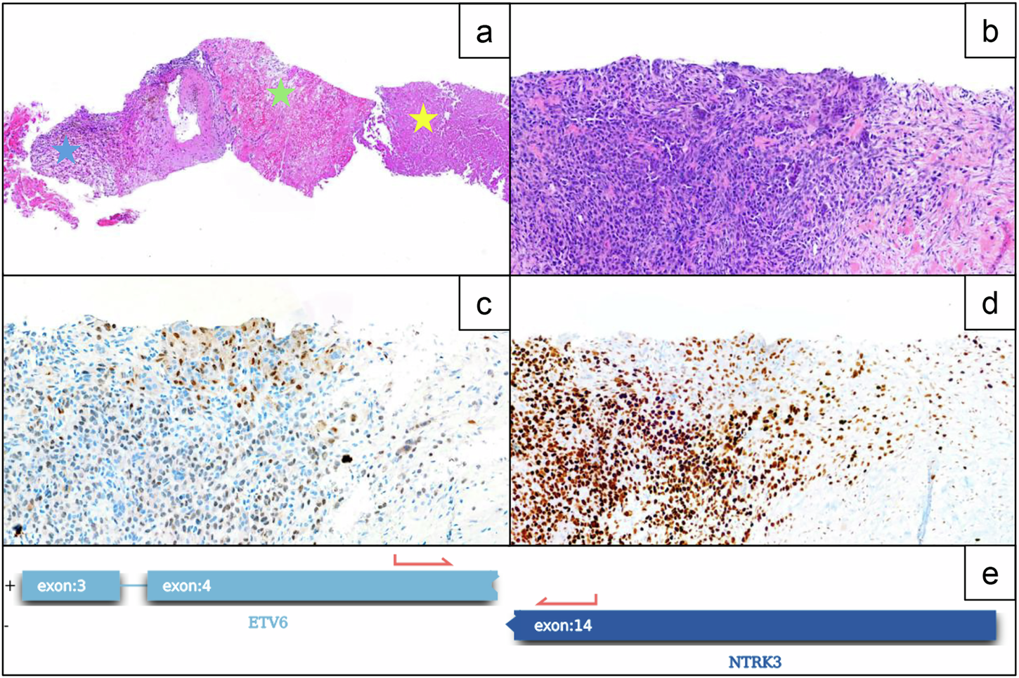 Fig. 1: Histological and molecular characteristics of the tumor.