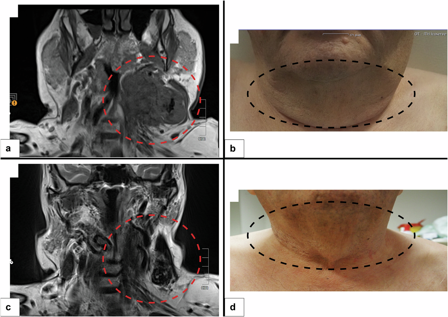 Fig. 2: Clinico-radiological correlation of the disease course.