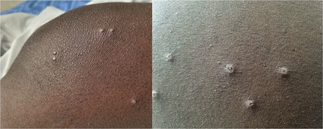 Fig. 2: Mpox lesions.