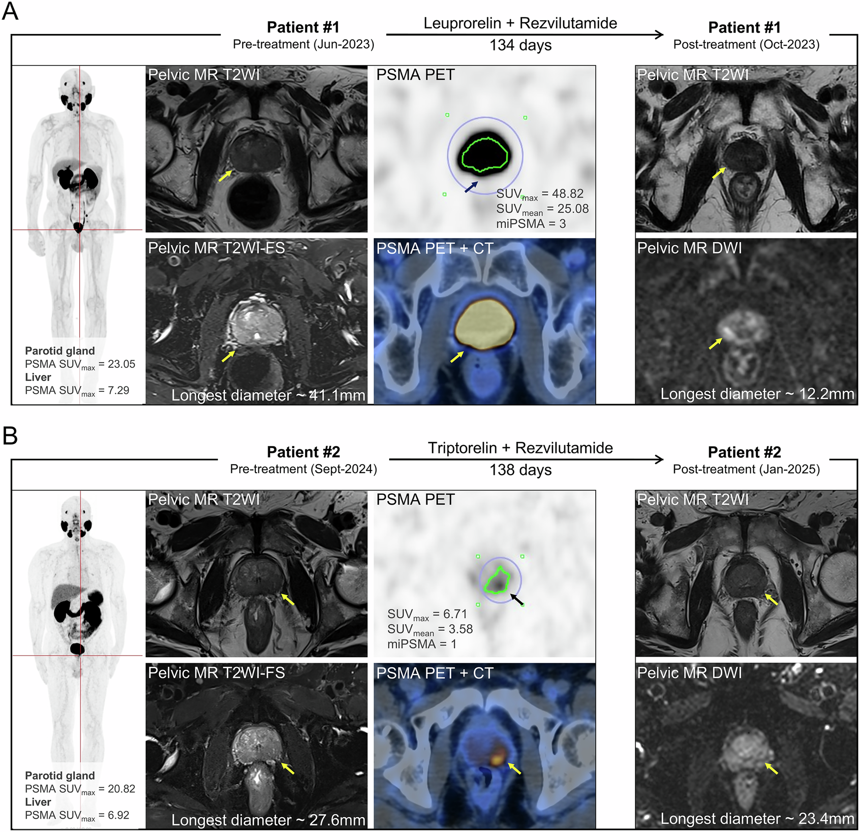 Fig. 5: Representative cases showing the correlation between [68Ga]Ga-PSMA-11 uptake and short-term response to ADT + ARPIs.