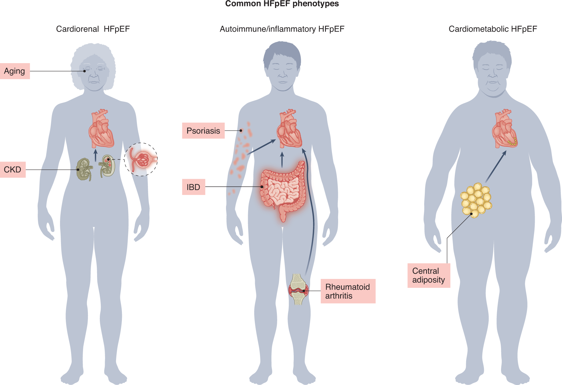 Physiogenex and Cardiomedex to present a new diabetic NASH HFpEF