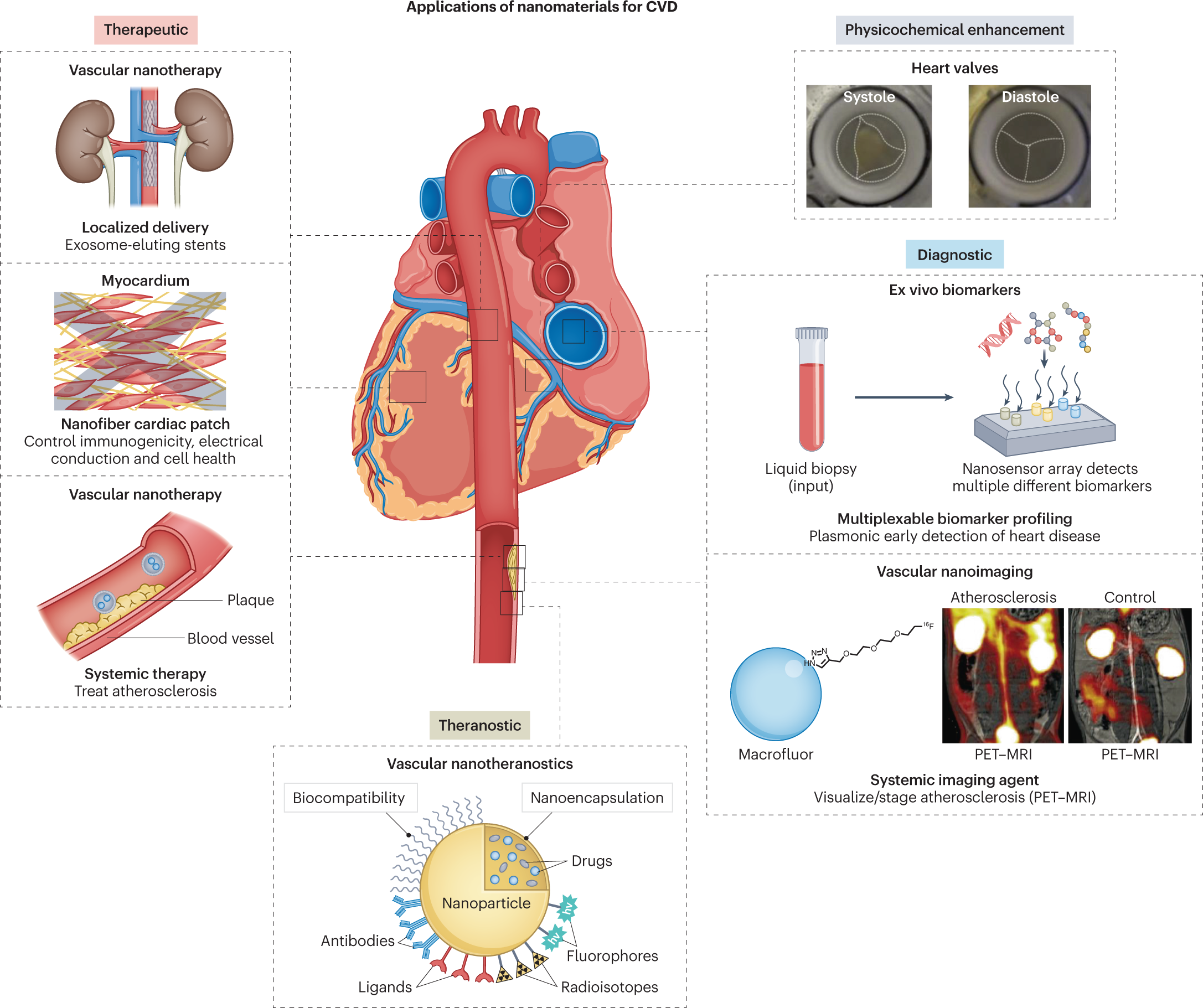 Major Study of Atherosclerotic Plaque Deposits Shows Potential Breakthrough  in Determining Risk for Heart Attacks