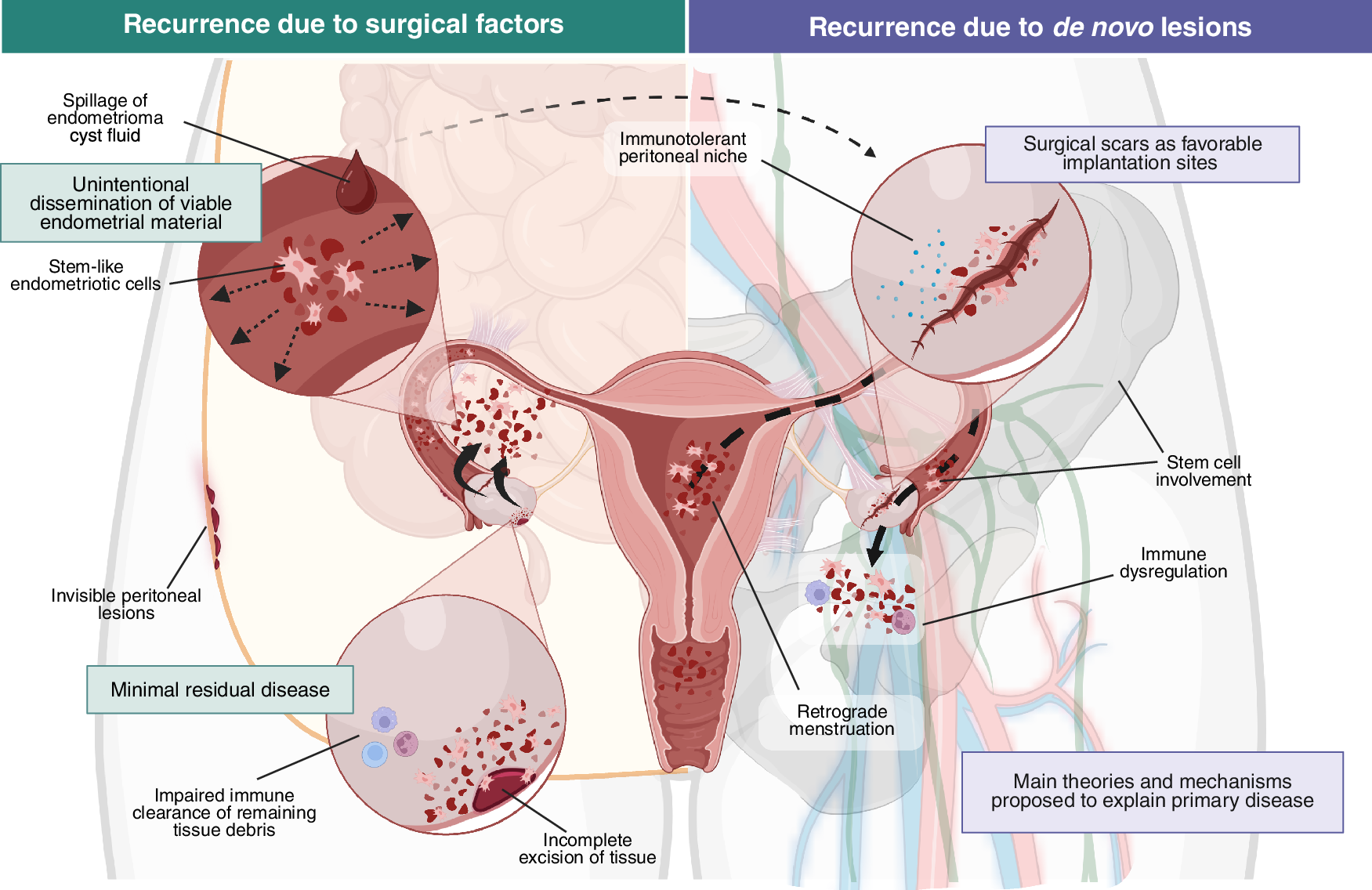 Fig. 1: Potential biological mechanisms of endometriosis recurrence.