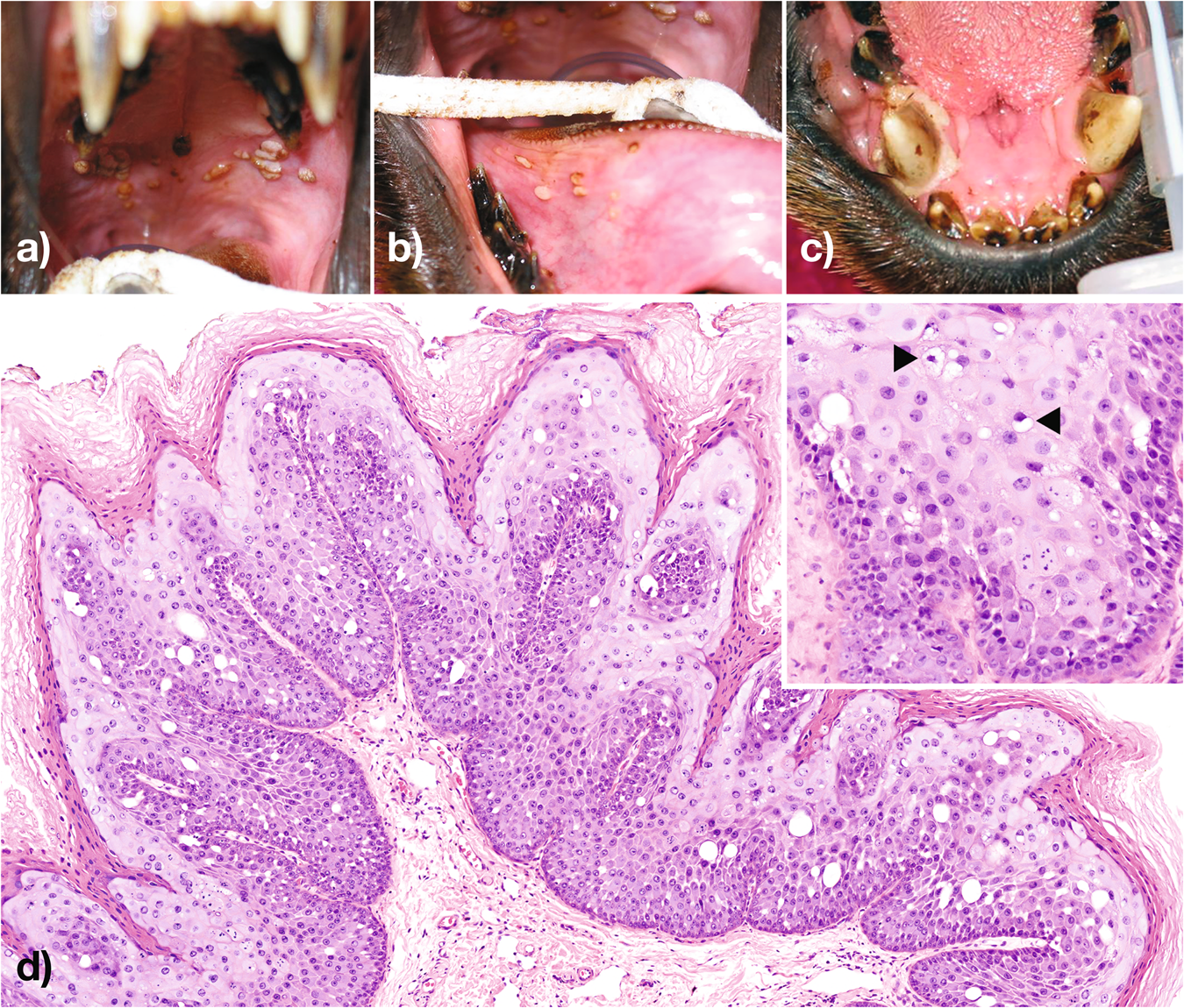 Fig. 1: Papillary proliferations, cellular atypia, and the presence of koilocytes in oral lesions.