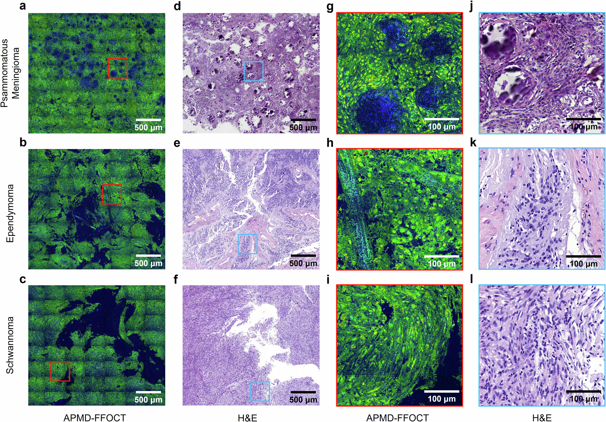Fig. 3: Comparison of APMD-FFOCT and H&E staining images in CNS tumors.
