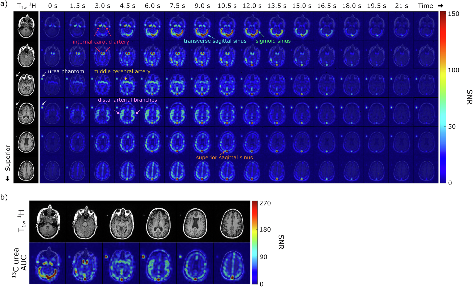 Fig. 2: Representative hyperpolarized [13C,15N2]urea images from a healthy brain volunteer.