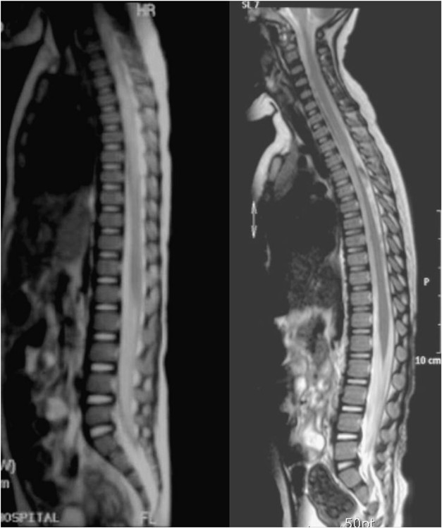 Progression of spinal cord atrophy by traumatic or inflammatory myelopathy  in the pediatric patients: case series | Spinal Cord