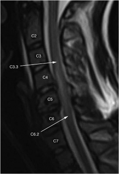 Magnetic resonance imaging in acute cervical spinal cord injury: a  correlative study on spinal cord changes and 1 month motor recovery | Spinal  Cord
