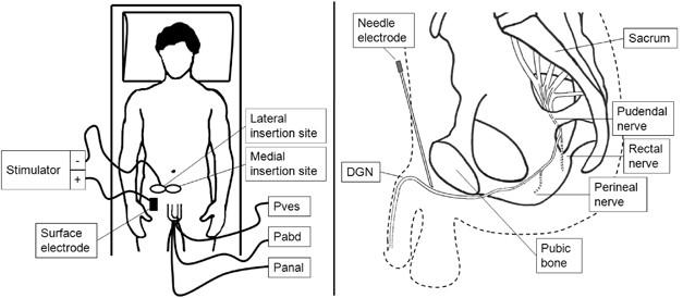 Dick Cord Insertion Dick Cord Insertion