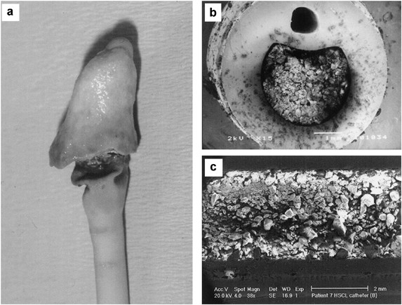 The encrustation and blockage of long-term indwelling bladder catheters: a  way forward in prevention and control | Spinal Cord