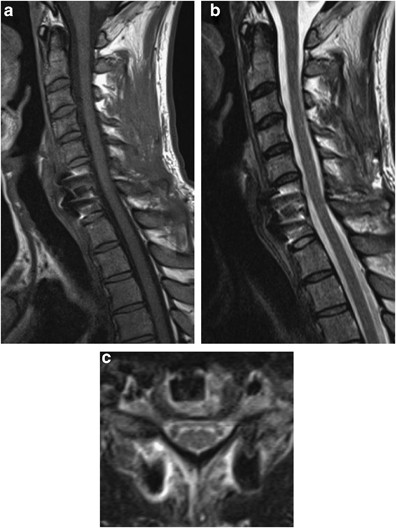 MRI in acute and subacute post-traumatic spinal cord injury: pictorial  review | Spinal Cord