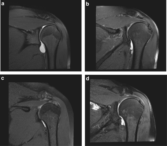 binary close Derivation Acromioclavicular joint arthrosis in persons with spinal cord injury and able-bodied persons | Spinal Cord binary close Derivation Acromioclavicular joint arthrosis in persons with spinal cord injury and able-bodied persons | Spinal Cord