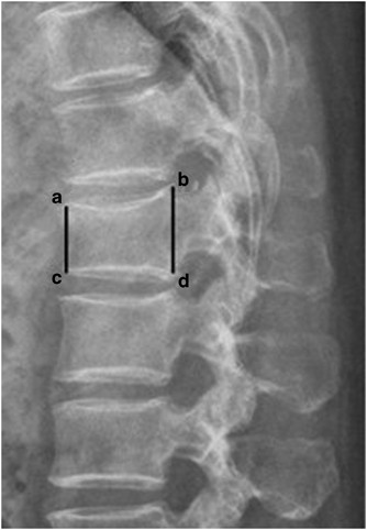 The correlation between vertebral wedge-shaped changes in X-ray
