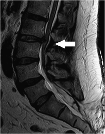 Myelopathy Due To Lumbar Disc Herniation In The Presence Of A Tethered Cord  | Spinal Cord