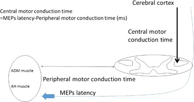 Characteristics Of C6 7 Myelopathy Assessment Of Clinical Symptoms And Electrophysiological Findings Spinal Cord