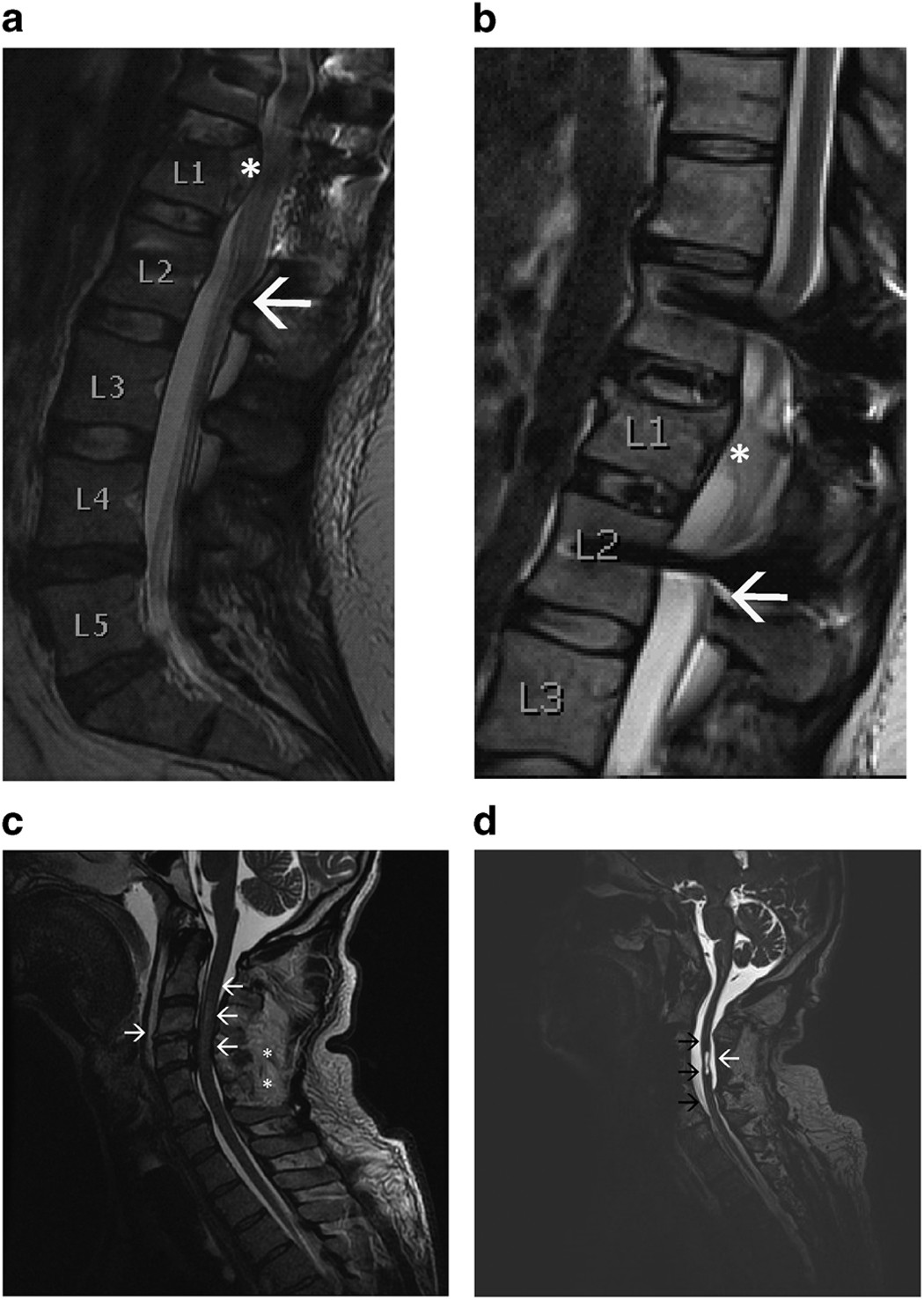 Long Term Paired Associative Stimulation Can Restore Voluntary Control Over Paralyzed Muscles In Incomplete Chronic Spinal Cord Injury Patients Spinal Cord Series And Cases