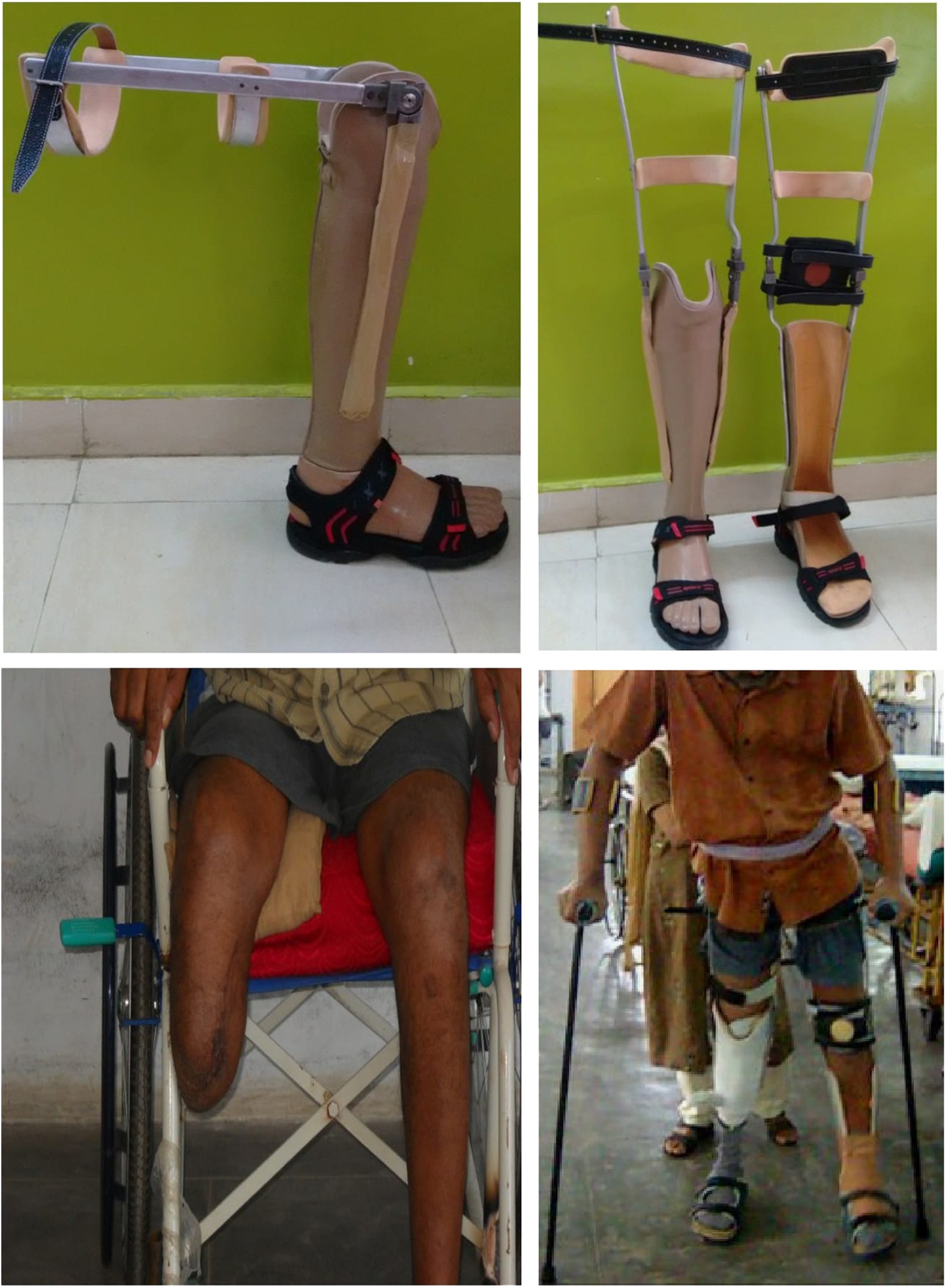 Focus on Bilateral Above-Knee Amputees - Amputee Coalition