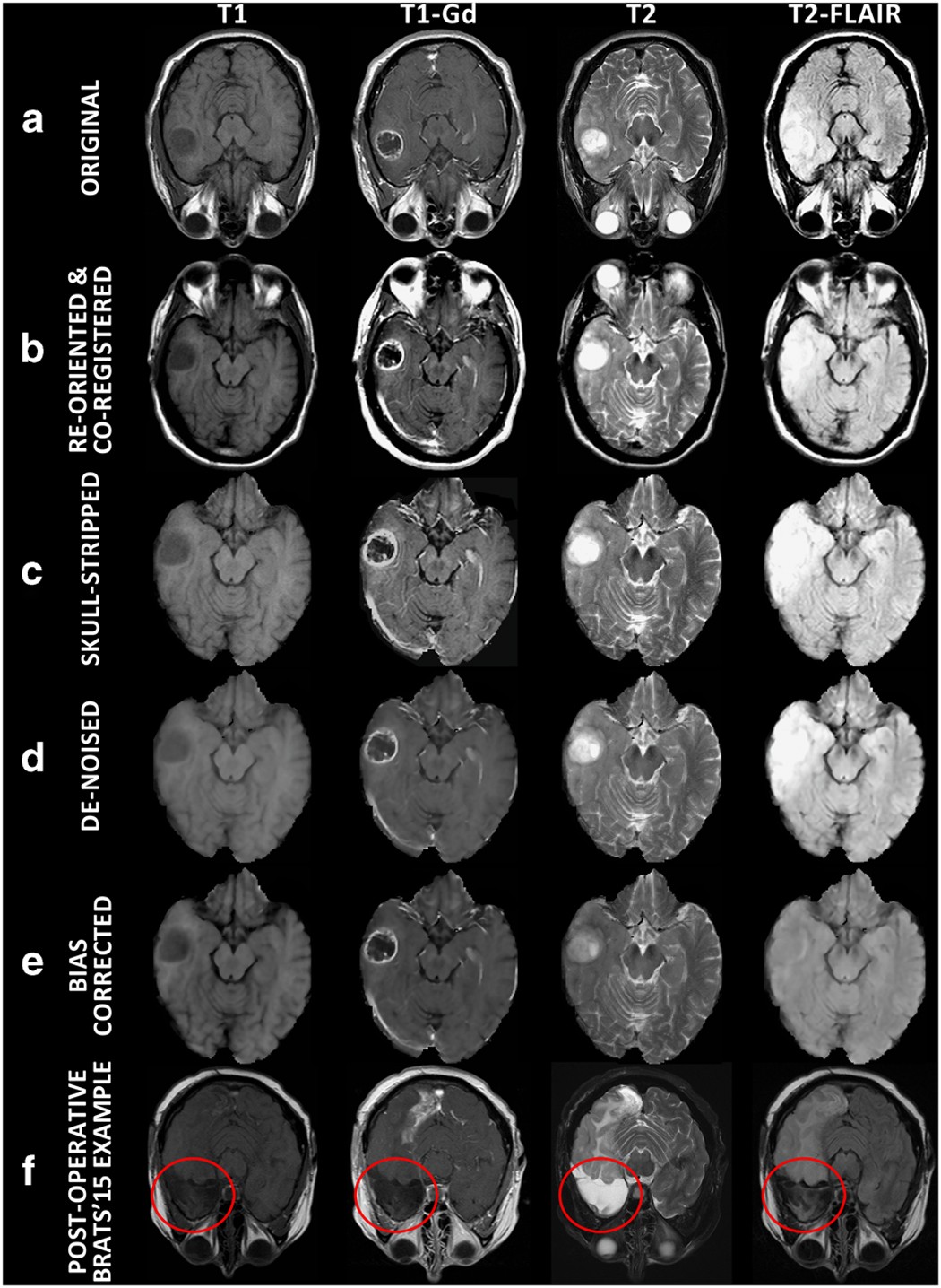 brain scan with tumor