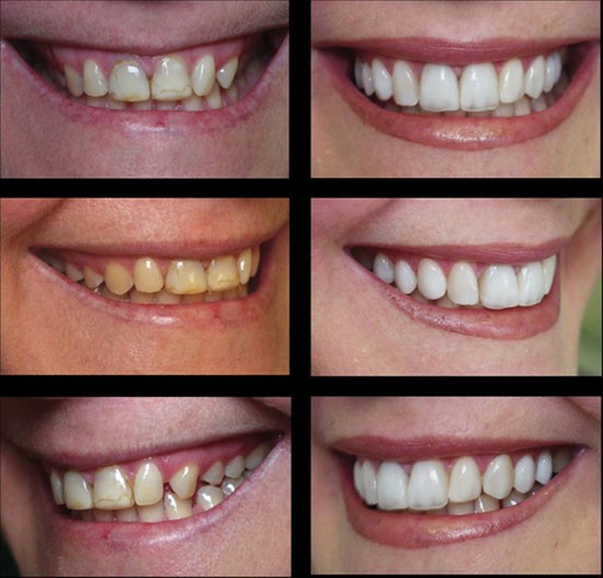 The effect of veneers on cosmetic improvement | British Dental Journal