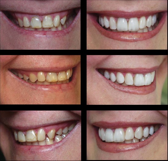 What Are The Differences Between Composite Resin Bonding & Veneers?