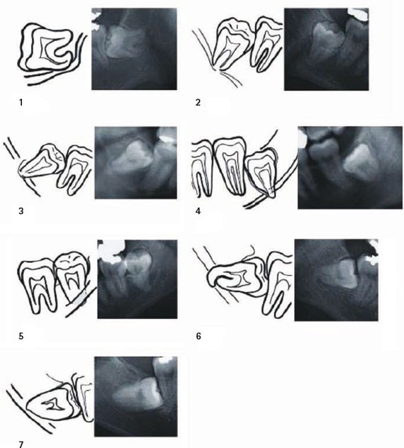 Mandibular nerve dental surgery