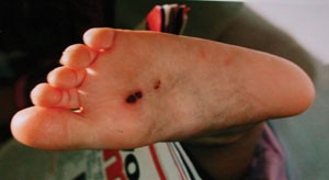 abuse cigarette burns on skin Forensic odontology, part 5. Child abuse issues